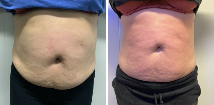 belly 1