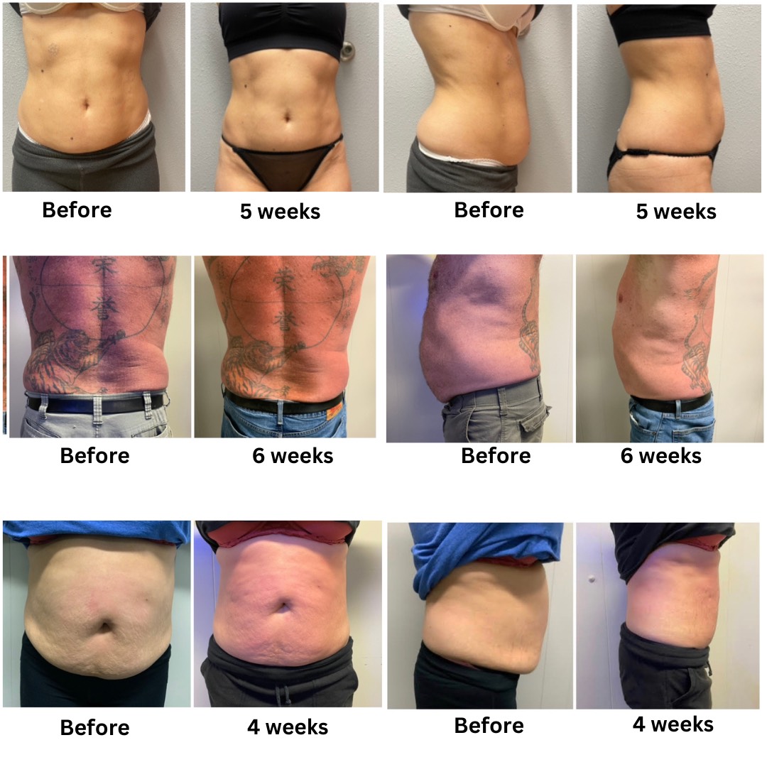 BODY CONTOURING, CIRCUMFERENTIAL REDUCTION AND FAT LOSS - Aesthetics &  Medical Lasers of Colorado